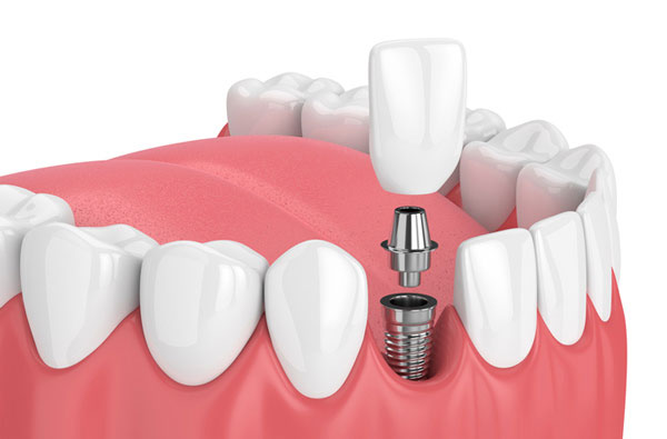 Implants